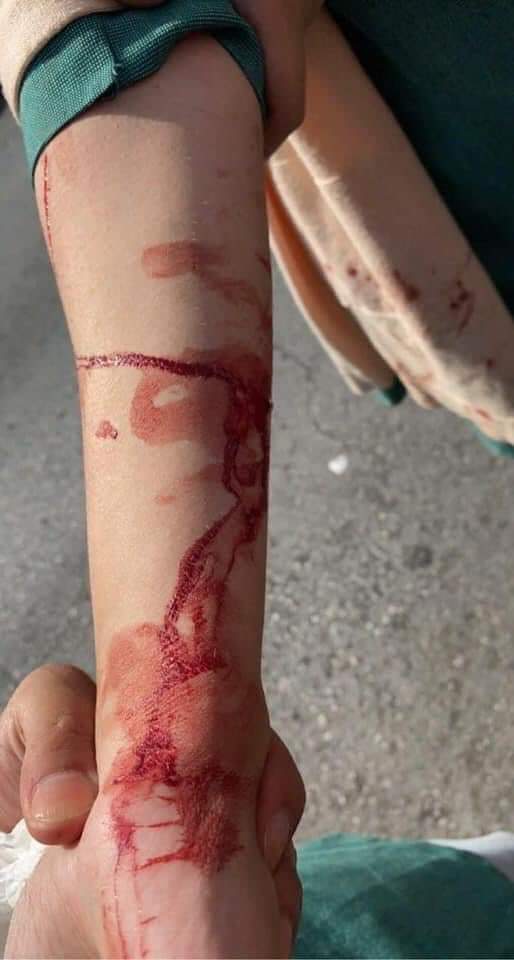 تعرض طالبة في إحدى المدارس الحكومية للضرب بأداة حادة