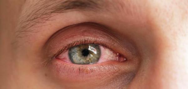 ما هو علاج رمد العين