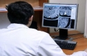 علامات خفية للجلطة الدماغية الدقيقة