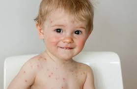 جدري الماء عند الأطفال.. طرق منزلية لتخفيف الحكة