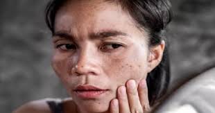 نادرة وتحدث بسبب التدفئة البسيطة.. ما هى متلازمة الجلد المحمص