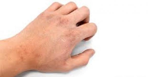 علامات تشير إلى تلف الكلى تظهر على الجلد