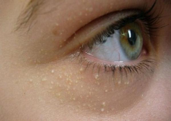 الرؤوس البيضاء في الوجه .. ما هي؟ وما أسباب ظهورها؟