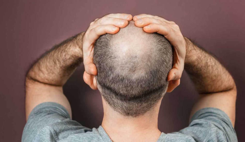 في شكوى رسمية .. امرأة تتهم زوجها بخداعها وإخفاء صلعه