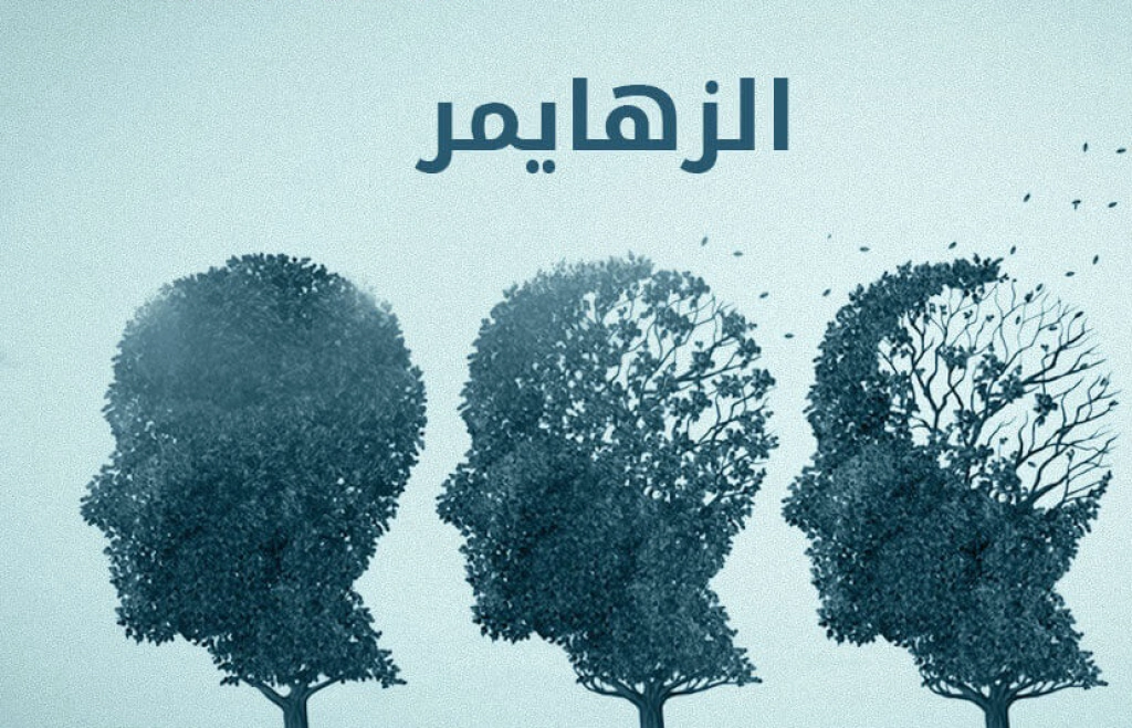 باحثون يطورون علاجا يوقف الزهايمر قبل ظهور الأعراض