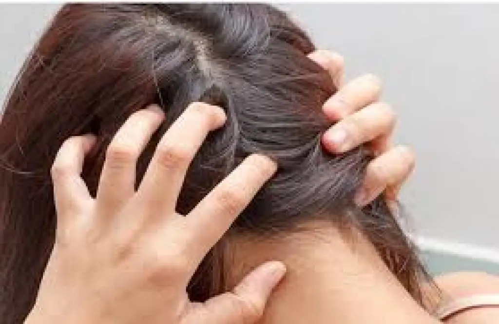 أسباب حرقة فروة الراس.. تعرف عليها