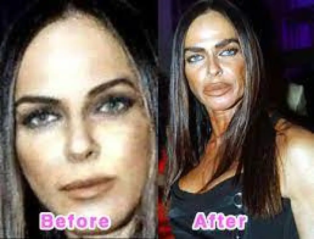 أسوأ عمليات التجميل في العالم.. كوارث عمليات التجميل!!