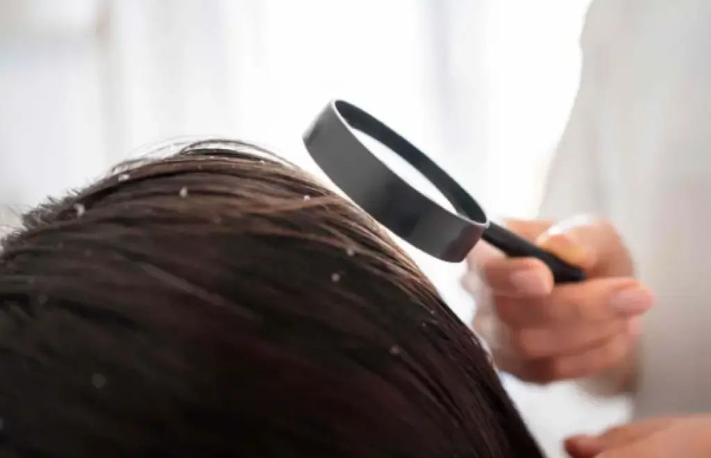 القضاء على قشرة الشعر ممكن بأساليب طبيعية وعمليّة