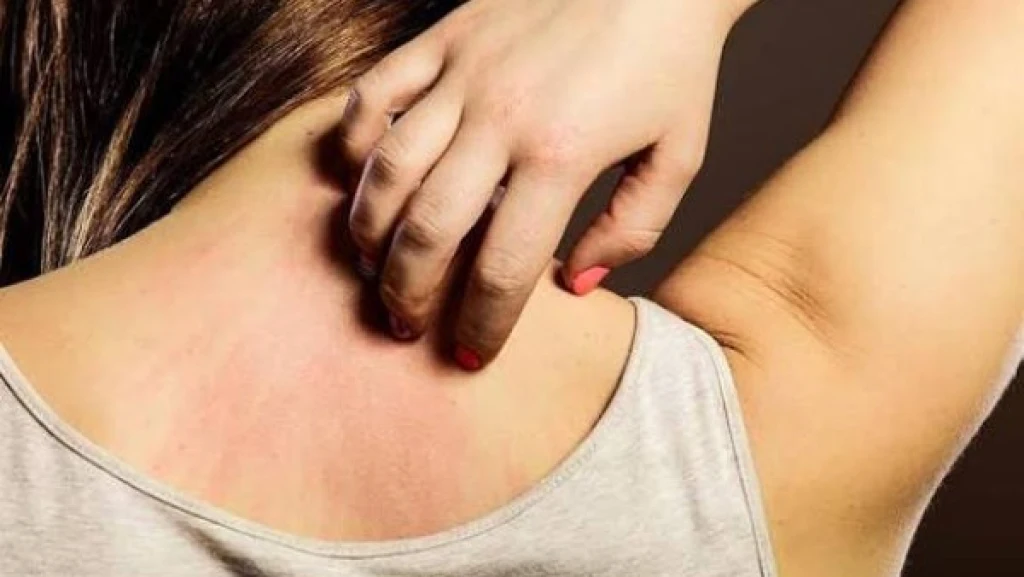 أسباب الحكة الجلدية.. متى تكون علامة مرضية وكيفية علاجها؟