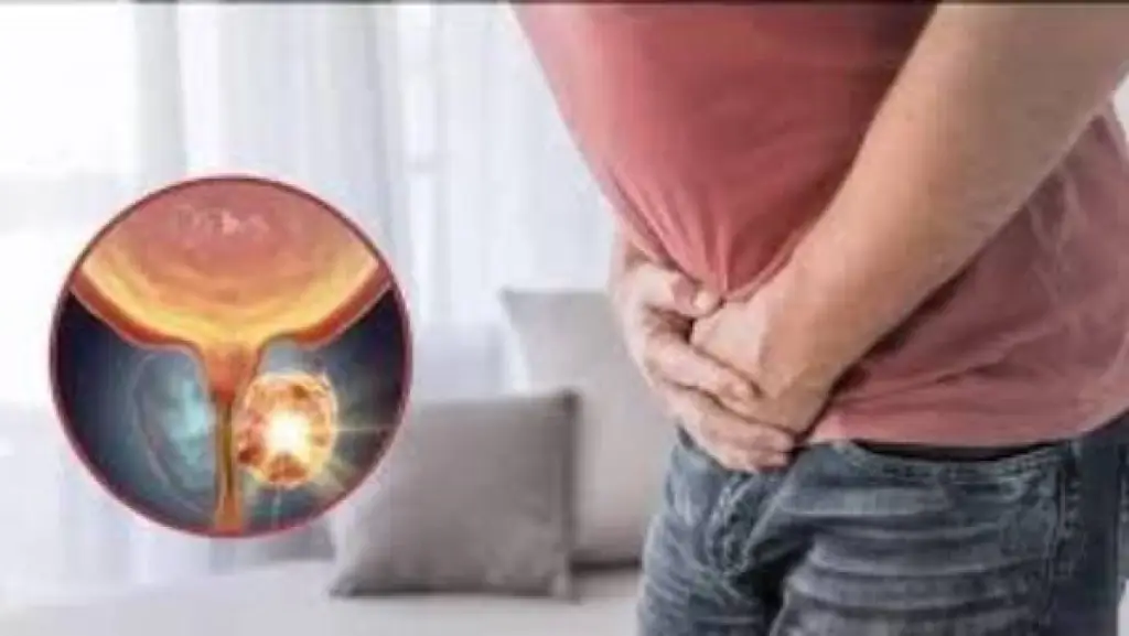 هل التبول الليلي المتكرر علامة على سرطان البروستاتا؟.. مفاجأة